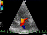心臓超音波検査
